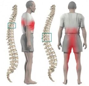 pain in spinal cord injury and thoracic osteochondrosis