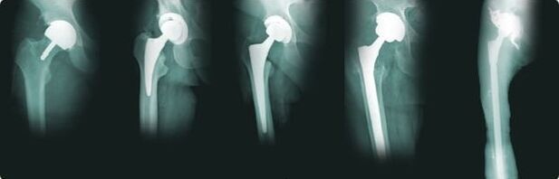 hip replacement options in arthrosis