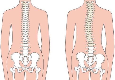 Back pain due to spinal deformity such as scoliosis