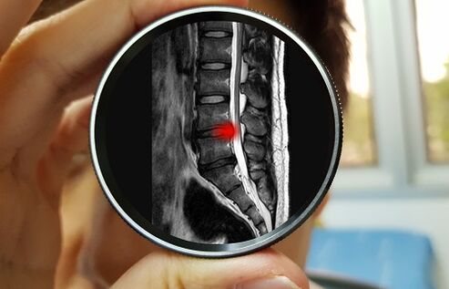 Ignoring back pain can result in a herniated disc. 