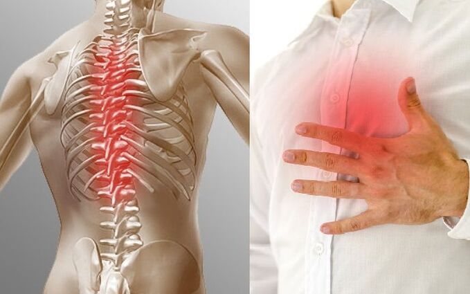 Thorakal osteocondrosis and chest pain