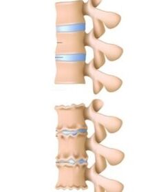 causes of osteochondrosis